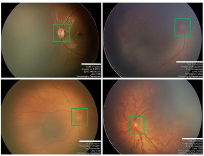 AFENet: Attention Fusion Enhancement Network for Optic Disc Segmentation of Premature Infants